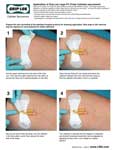 Application of Grip Lok Large Foley Catheter